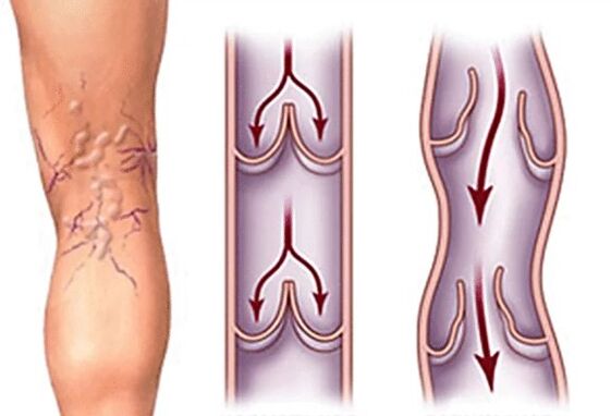 Normal vein and extended
