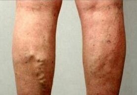 Thromboembolism