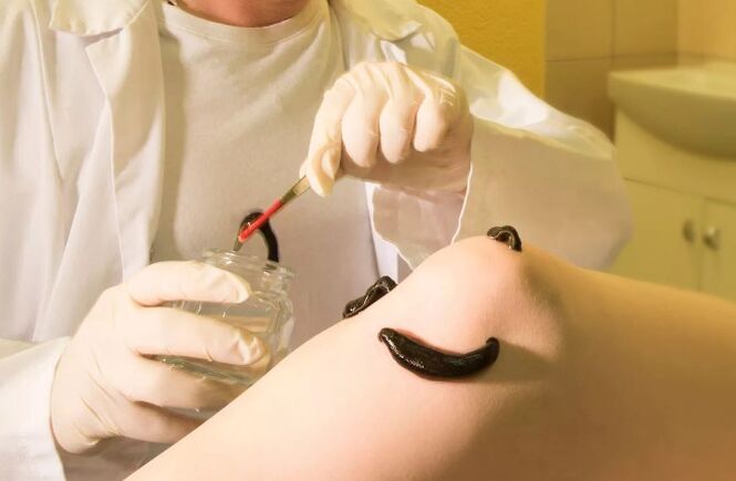Varicose therapy for varicose veins