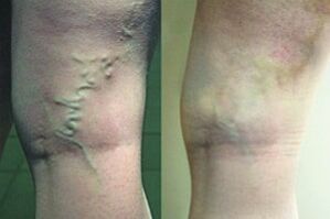 Varicose veins