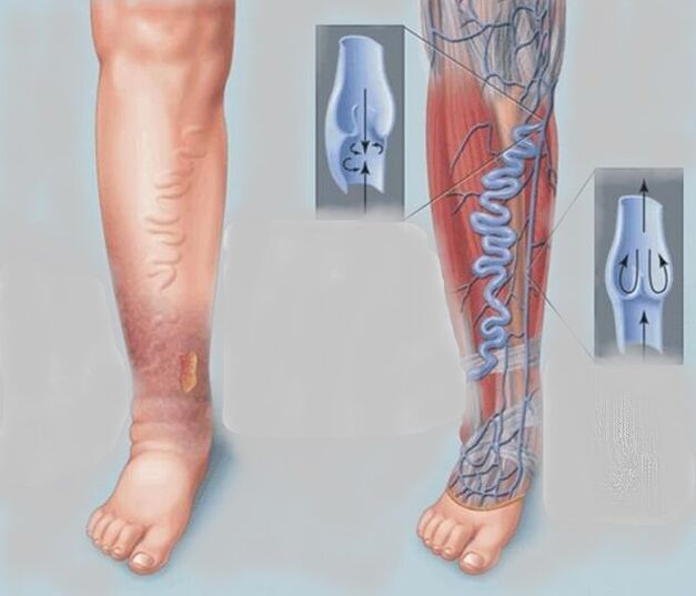 Varicose veins