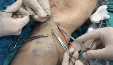 How phlebotomy is performed to remove varicose veins