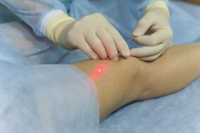 surgical intervention for varicose veins of the legs