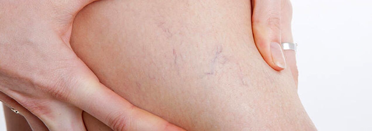 Spider veins with varicose veins